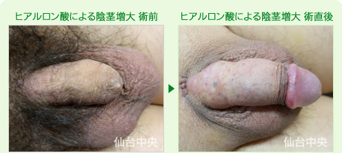 ヒアルロン酸による陰茎増大 症例写真1
