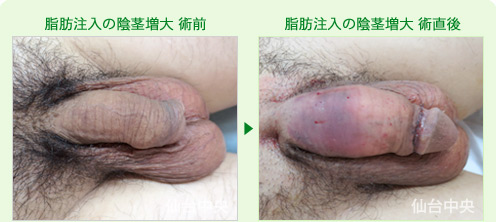 脂肪注入の陰茎増大 症例写真1