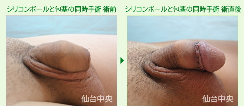 シリコンボールと包茎の同時手術 症例写真2