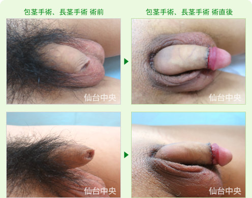 24歳、未婚。包茎手術、長茎手術