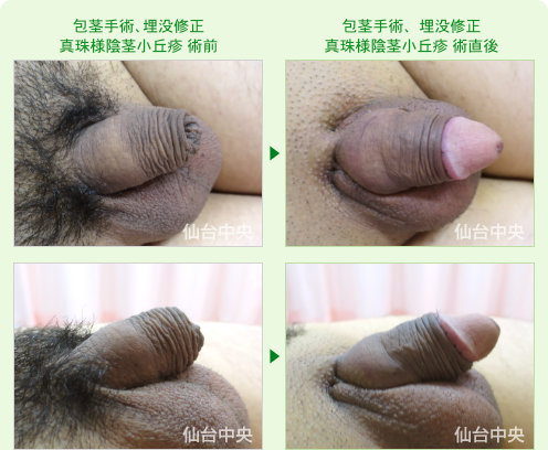 21歳、未婚。包茎手術、埋没修正、真珠様陰茎小丘疹