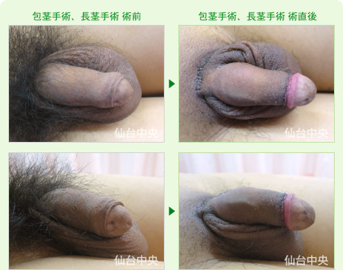 28歳、未婚。包茎手術、長茎手術