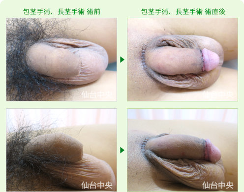 24歳、未婚。包茎手術、長茎手術