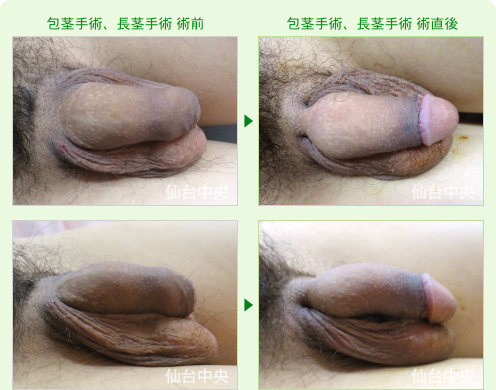 22歳、未婚。包茎手術、埋没修正