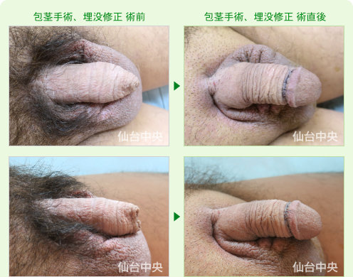 52歳、既婚。包茎手術、埋没修正