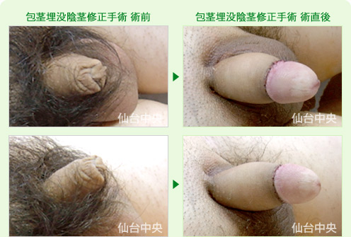 包茎埋没陰茎修正手術