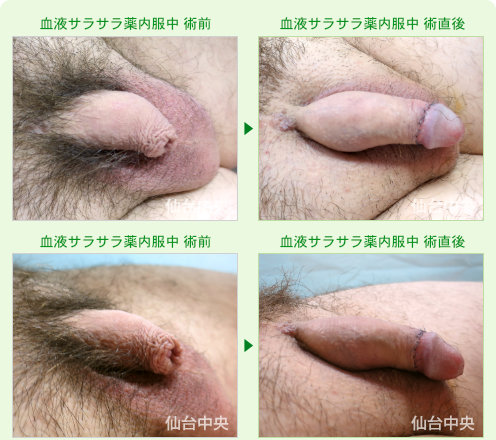 血液サラサラ薬内服中の包茎手術 症例写真