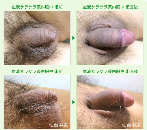 血液サラサラ薬内服中の包茎手術 症例写真