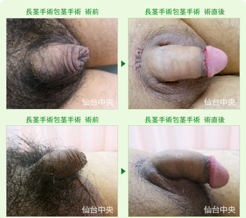 包茎、長茎同時手術症例写真。術前と術直後 - 30代男性