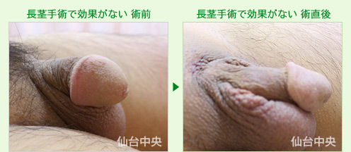 長茎手術で効果がない 症例写真2