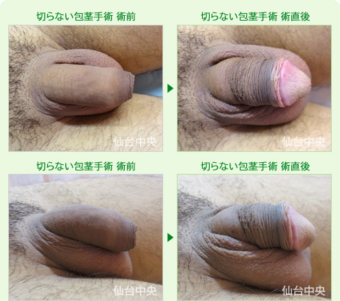 切らない包茎手術　症例写真2