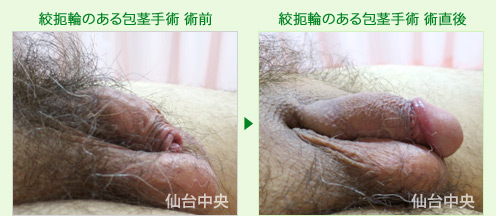 絞扼輪のある包茎手術 症例写真2