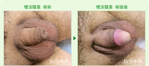 埋没陰茎の症例写真、術前と術直後の比較 - 50代、男性