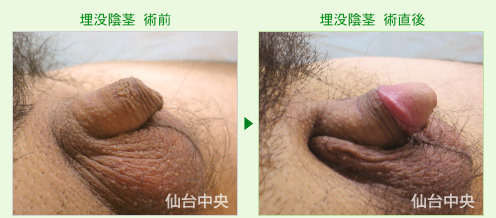 埋没陰茎の症例写真、術前と術直後の比較 - 50代、男性