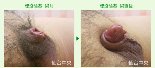 埋没陰茎の症例写真、術前と術直後の比較 - 60代、男性