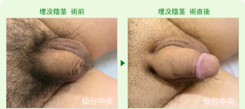 埋没陰茎の症例写真、術前と術直後の比較 - 40代、男性