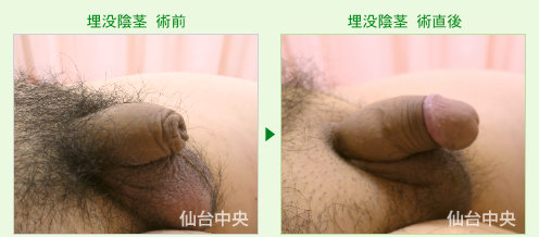 埋没陰茎の症例写真、術前と術直後の比較 - 40代、男性