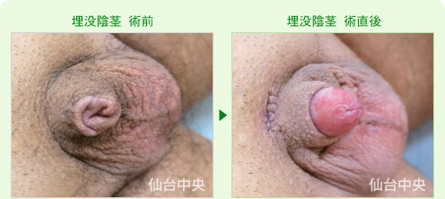 埋没陰茎の症例写真、術前と術直後の比較 - 30代、男性