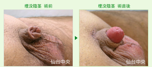埋没陰茎の症例写真、術前と術直後の比較 - 30代、男性
