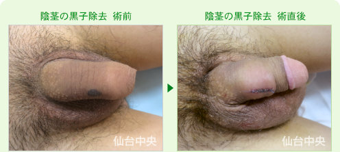 陰茎の黒子を取る手術 症例写真、術前と術直後の比較 - 20代、男性