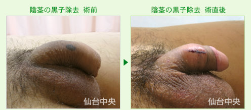 陰茎の黒子を取る手術 症例写真、術前と術直後の比較 - 20代、男性