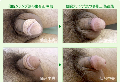 他院クランプ法の傷修正