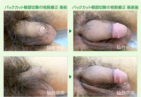 バックカット他院修正手術