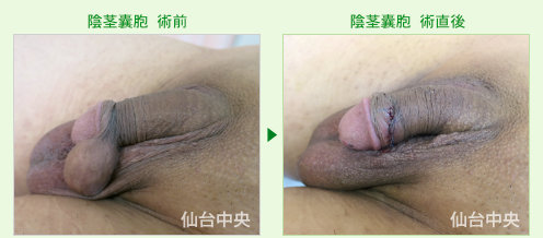 陰茎嚢胞の切除 症例写真、術前と術直後の比較 - 50代、男性