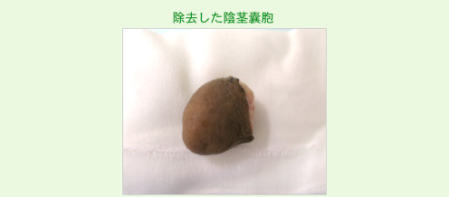 切除した陰茎嚢胞の写真