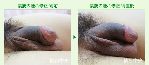 裏筋の腫れ修正 症例写真2