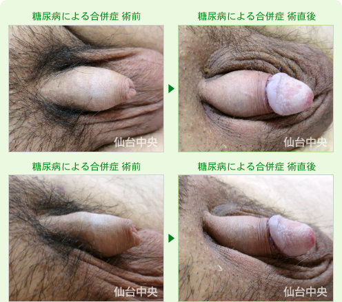 糖尿病の合併症 症例写真