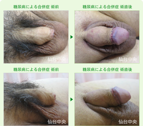 糖尿病の合併症 症例写真