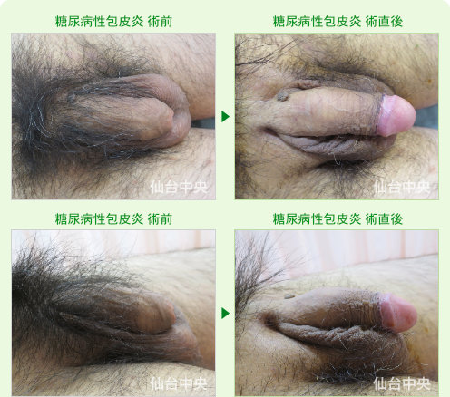 糖尿病性包皮炎 症例写真