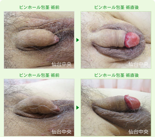 ピンホール包茎