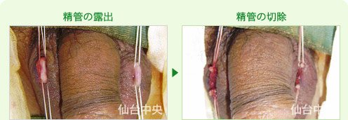 精管の露出と切除