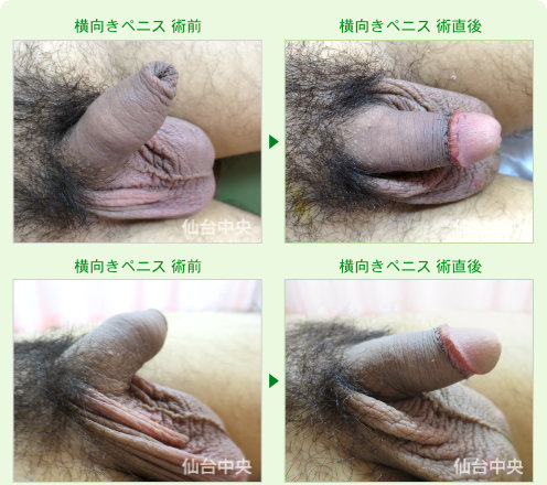横向きペニス 症例写真