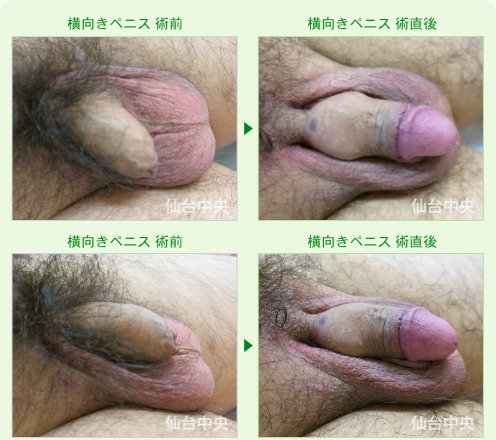 横向きペニス 症例写真