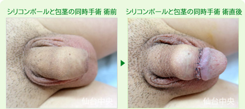 シリコンボールと包茎の同時手術 症例写真1