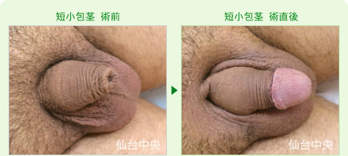 短小包茎手術の症例写真、術前と術直後の比較 - 20代、男性