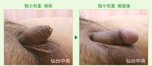 短小包茎手術の症例写真、術前と術直後の比較 - 20代、男性