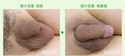 短小包茎、長茎手術の症例写真、術前と術直後の比較 - 20代、男性