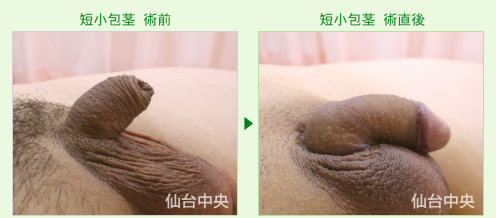 短小包茎、長茎手術の症例写真、術前と術直後の比較 - 20代、男性