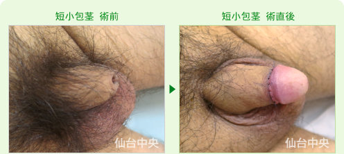 短小包茎の症例写真、術前と術直後の比較 - 40代、男性