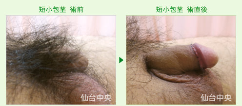 短小包茎の症例写真、術前と術直後の比較 - 40代、男性
