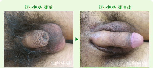 短小包茎の症例写真、術前と術直後の比較 - 40代、男性