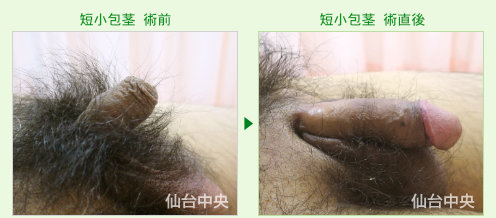 短小包茎の症例写真、術前と術直後の比較 - 40代、男性