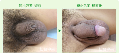 短小包茎の症例写真、術前と術直後の比較 - 30代、男性