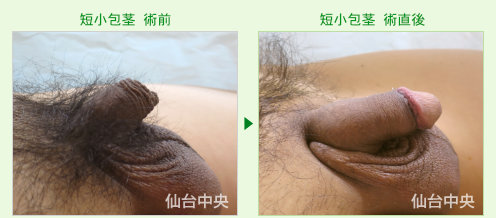 短小包茎の症例写真、術前と術直後の比較 - 30代、男性