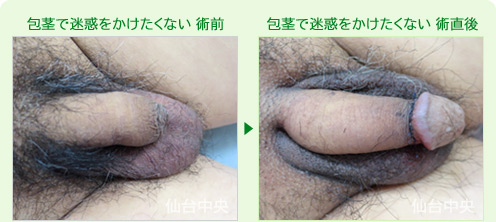 包茎で迷惑をかけたくない 症例写真1