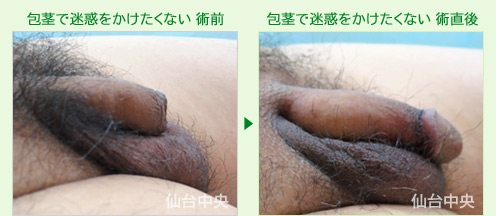 包茎で迷惑をかけたくない 症例写真2